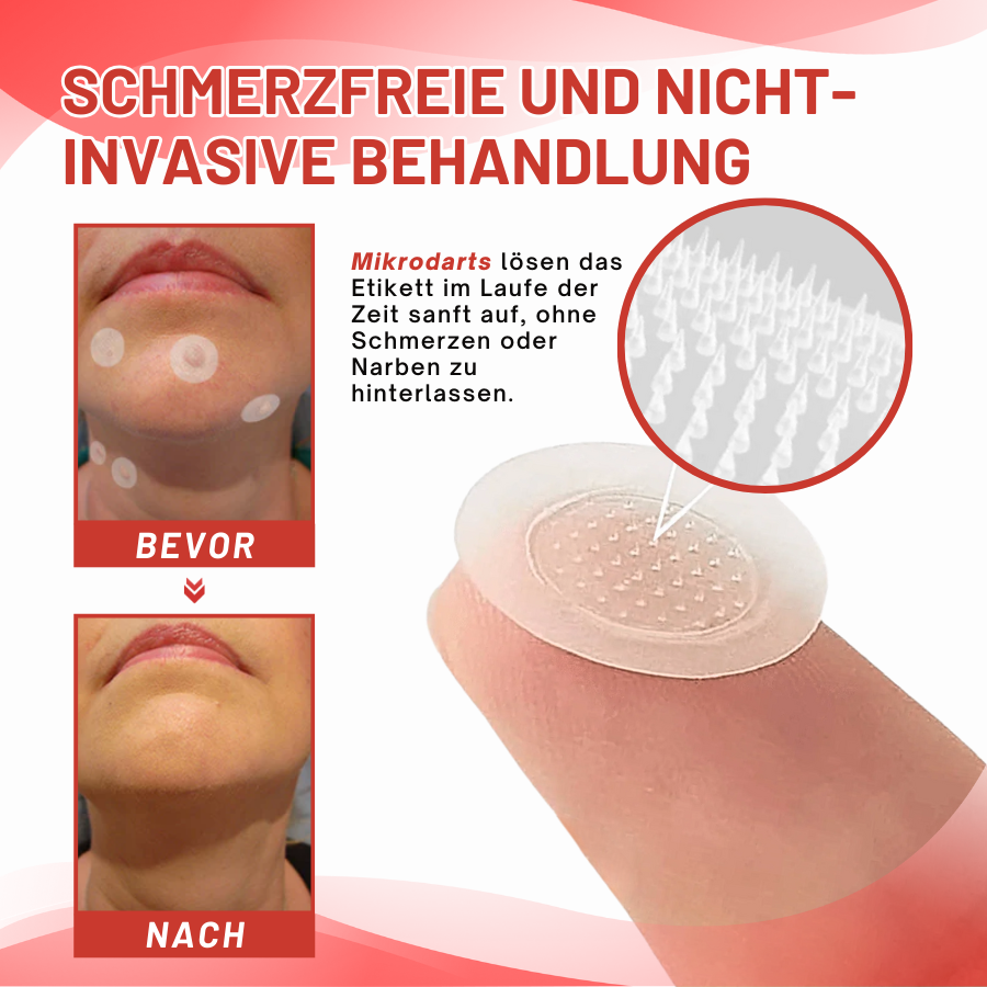 Fivfivgo® MicroDart Haut Tag Entferner Patch