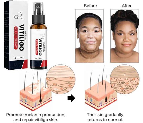 Fivfivgo™ Vitiligo-Linderungsspray