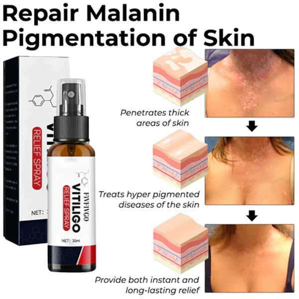 Fivfivgo™ Vitiligo-Linderungsspray