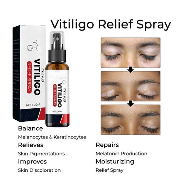 Fivfivgo™ Vitiligo-Linderungsspray