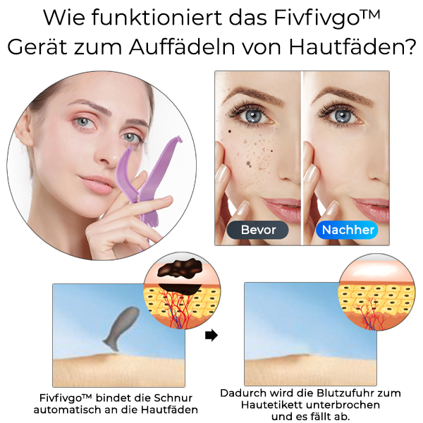 Fivfivgo™ Gerät zum Auffädeln von Hautfäden