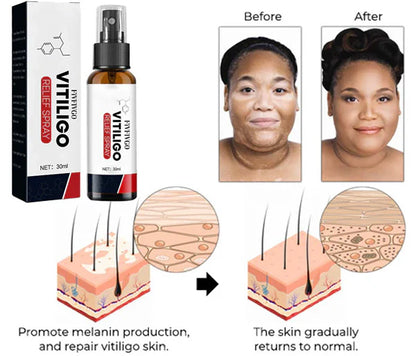 Fivfivgo™ Vitiligo-Linderungsspray