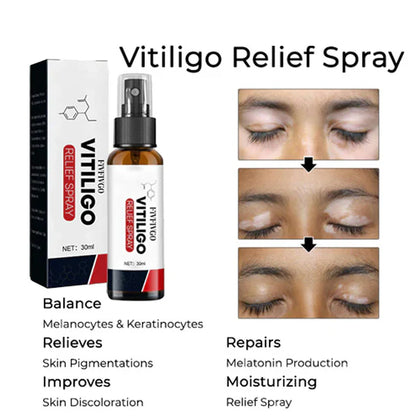 Fivfivgo™ Vitiligo-Linderungsspray
